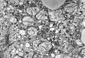 M,5y. | mitochondrial changes - Reye hepatocerebral syndrome M,5y. | mitochondrial changes - Reye hepatocerebral syndrome